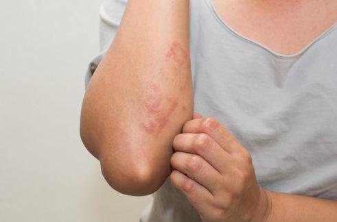 Dấu hiệu nhiễm HIV giai đoạn đầu? Hình ảnh phát ban HIV