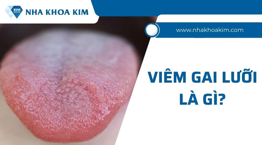 Nhận biết hình ảnh viêm gai lưỡi và cách điều trị